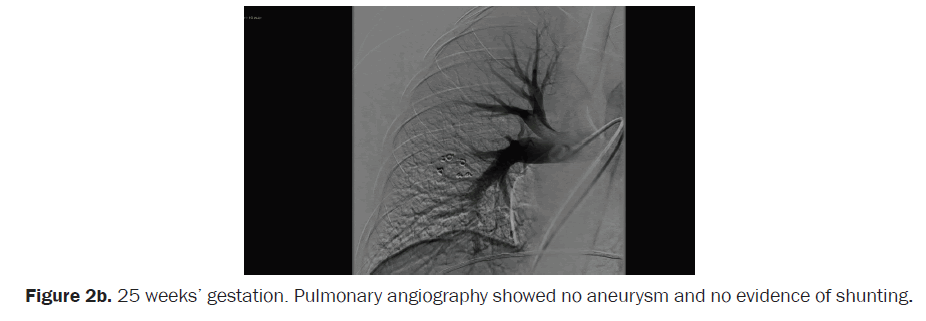 clinical-medical-Pulmonary-angiography