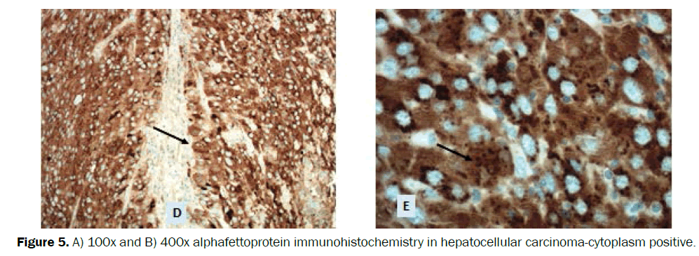 clinical-medical-carcinoma-cytoplasm