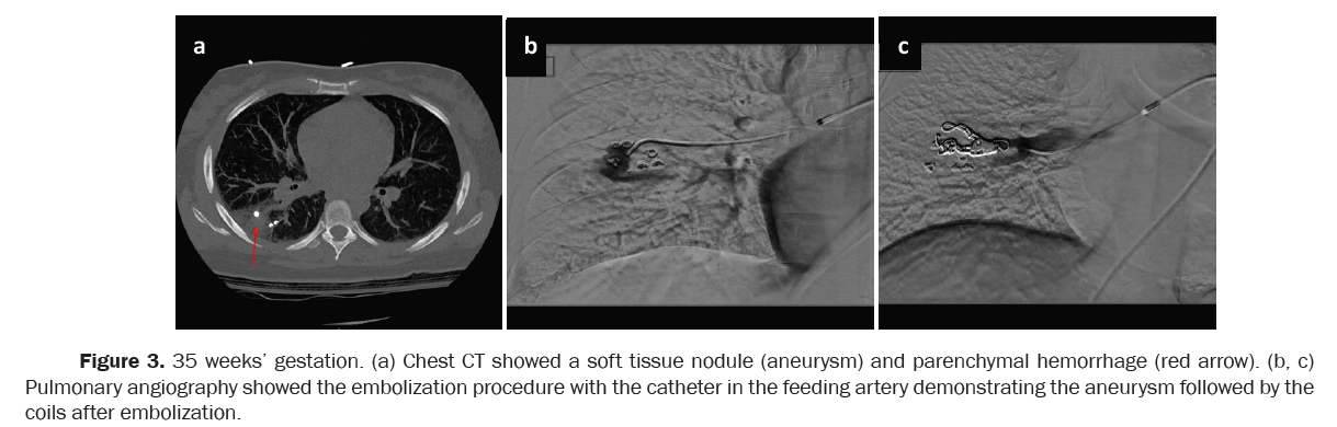 clinical-medical-embolization-procedure