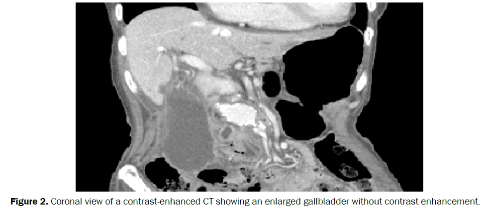 clinical-medical-enlarged-gallbladder