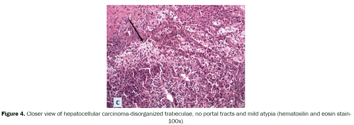 clinical-medical-hepatocellular-carcinoma