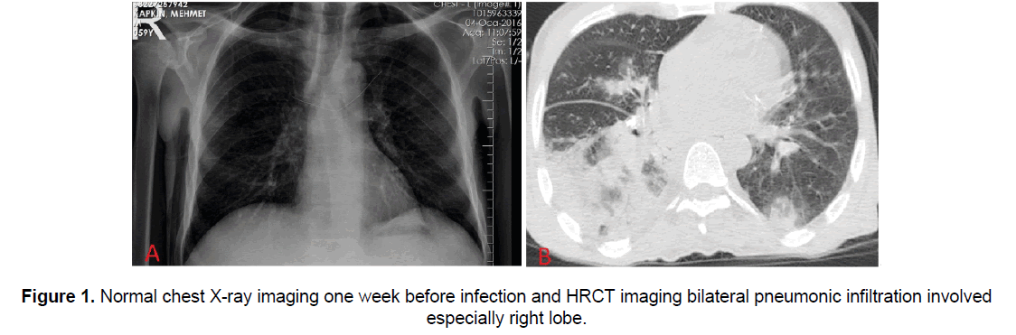 clinical-medical-infection-HRCT