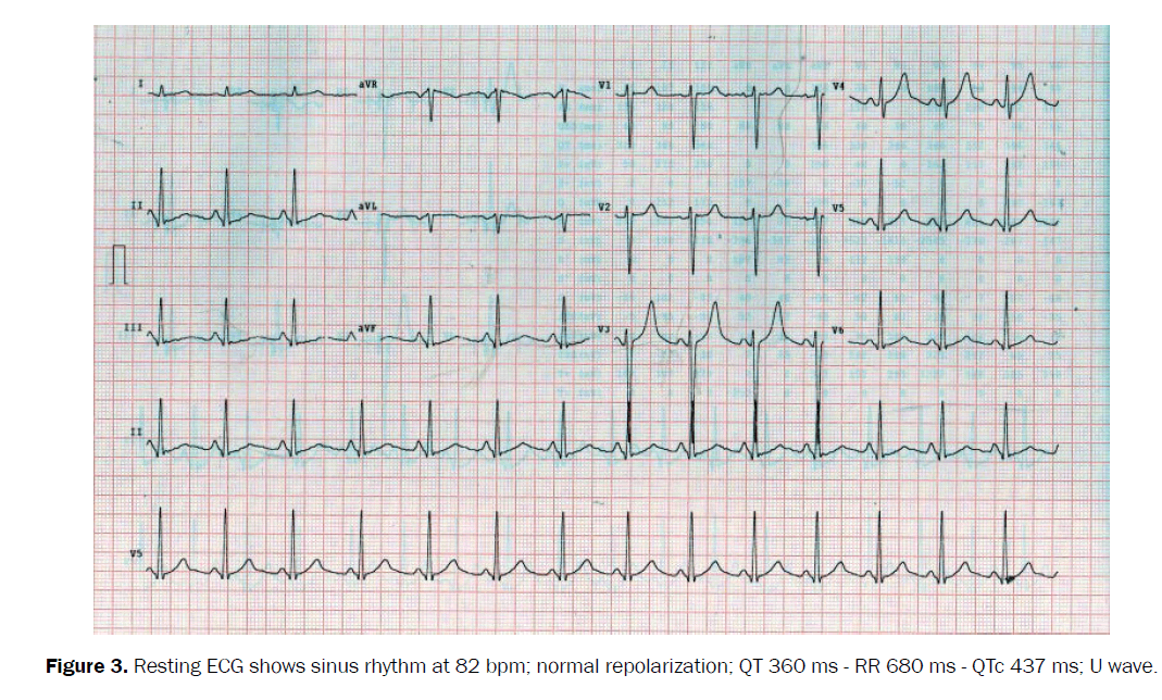 ejbio-sinus-rhythm