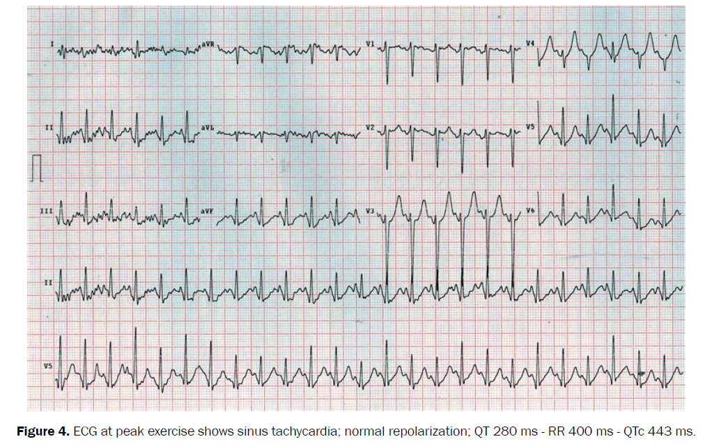 ejbio-sinus-tachycardia