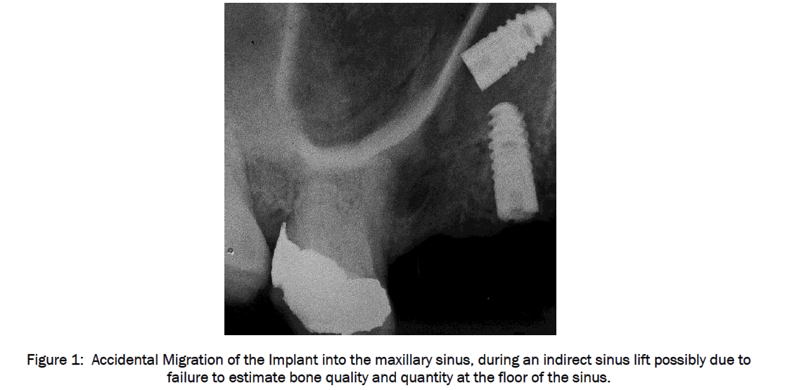 dental-sciences-Accidental-Migration-Implant