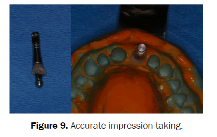 dental-sciences-Accurate-impression-taking
