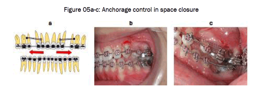 dental-sciences-Anchorage-control-space-closure