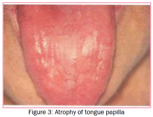 dental-sciences-Atrophy