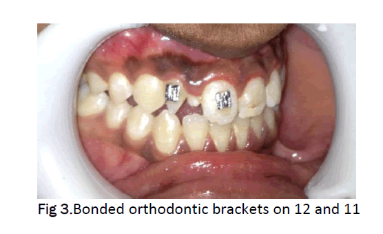 dental-sciences-Bonded-orthodontic-brackets