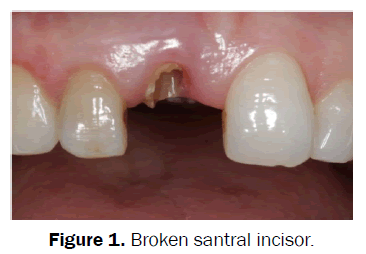 dental-sciences-Broken-santral-incisor