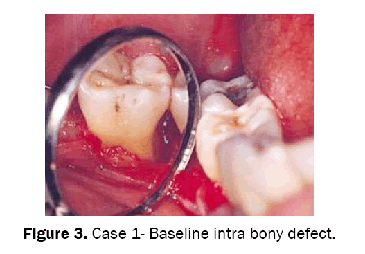 dental-sciences-Case-Baseline-intra-bony-defect