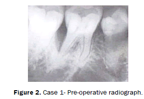 dental-sciences-Case-Pre-operative-radiograph