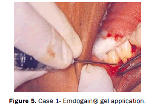 dental-sciences-Case-gel-application