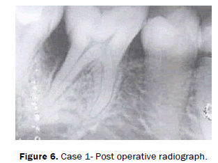 dental-sciences-Case-gel-application