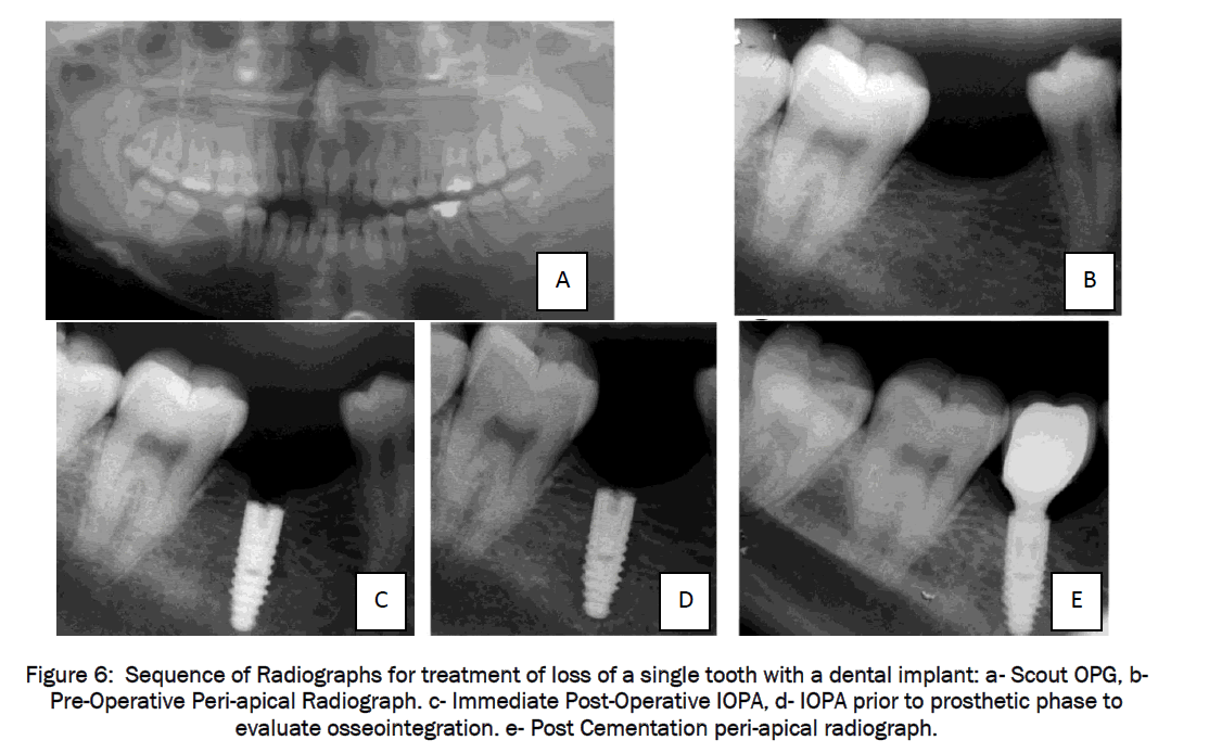 dental-sciences-Cementation-peri-apical-radiograph