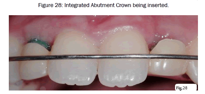 dental-sciences-Crown-being-inserted