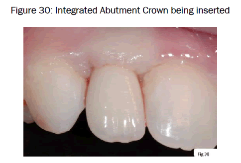 dental-sciences-Crown-being-inserted