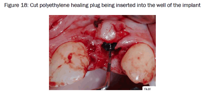 dental-sciences-Cut-polyethylene-healing