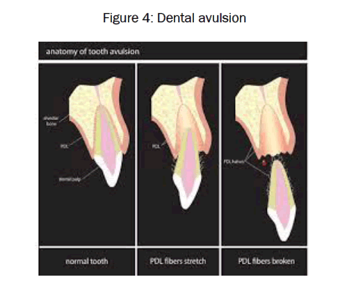 dental-sciences-Dental-avulsion