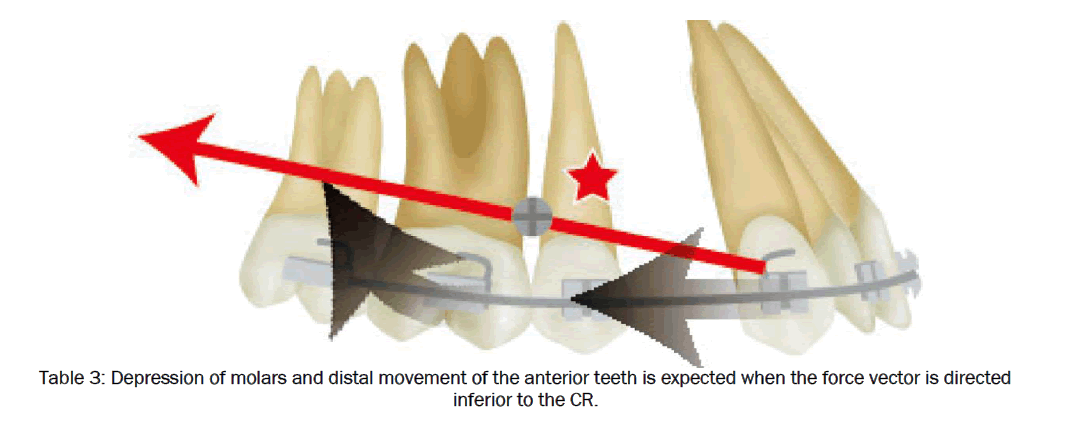 dental-sciences-Depression-molars-distal