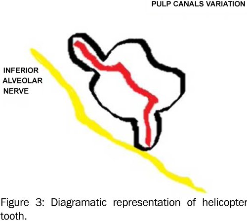 dental-sciences-Diagramatic-helicopter-tooth