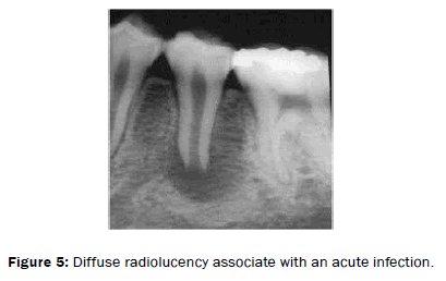 dental-sciences-Diffuse-radiolucency