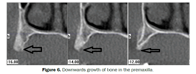 dental-sciences-Downwards-growth-bone