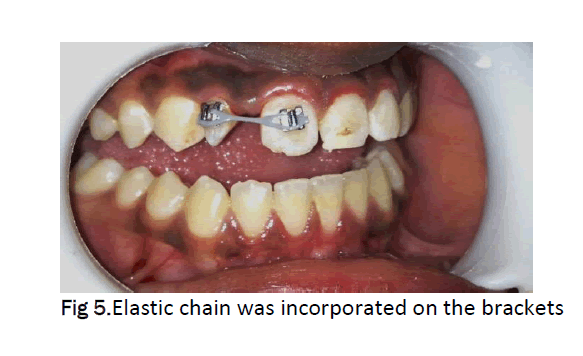 dental-sciences-Elastic-chain-incorporated