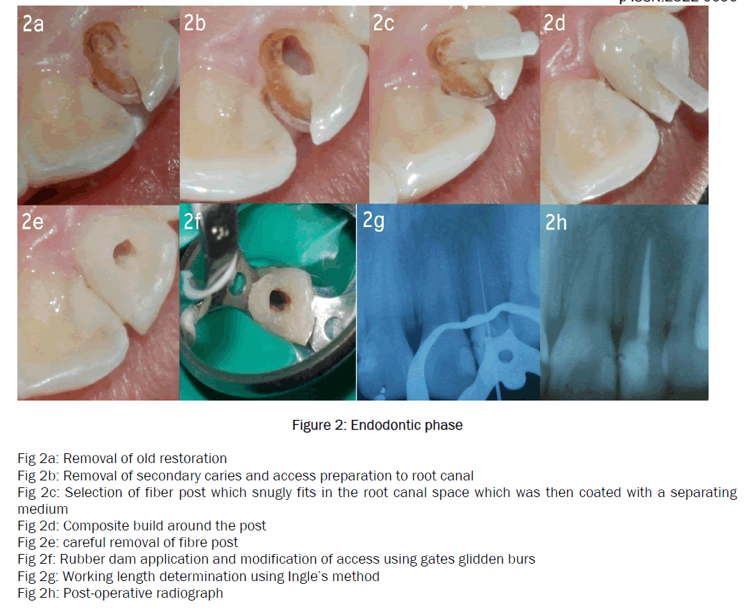 dental-sciences-Endodontic