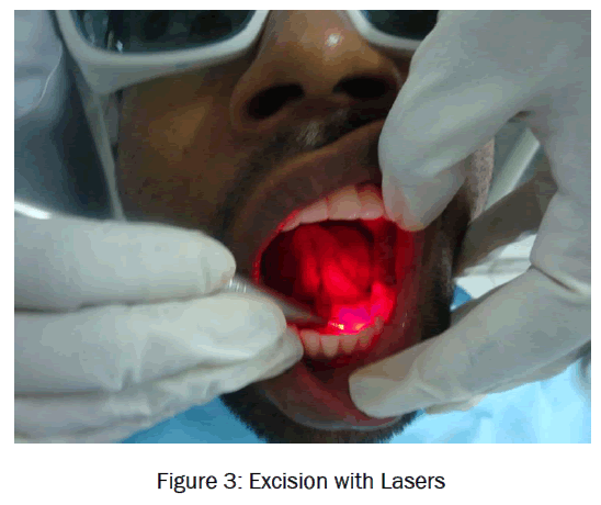 dental-sciences-Excision-Lasers