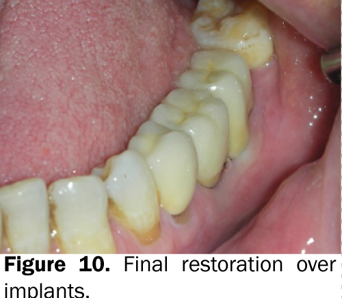 dental-sciences-Final-restoration-implants