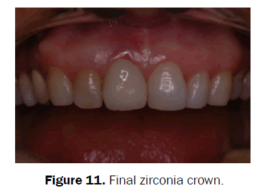 dental-sciences-Final-zirconia-crown