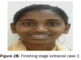 dental-sciences-Finishing-stage-extraoral-case