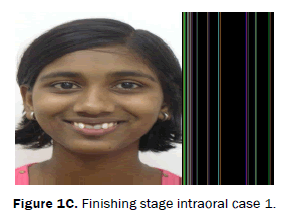 dental-sciences-Finishing-stage-intraoral-case