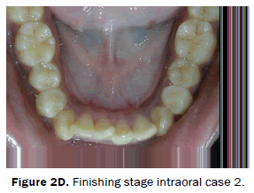 dental-sciences-Finishing-stage-intraoral-case