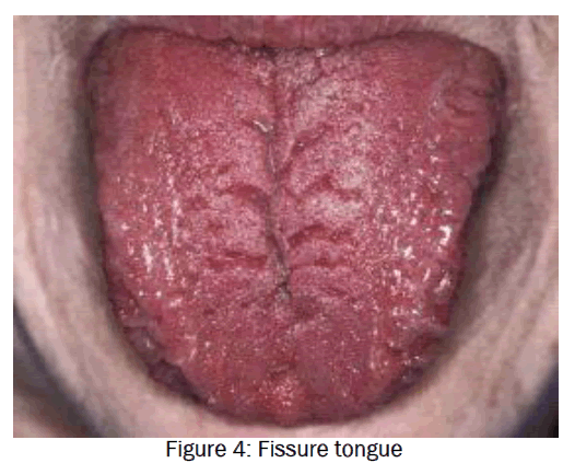 dental-sciences-Atrophy