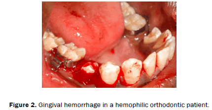 dental-sciences-Gingival-hemorrhage-hemophilic