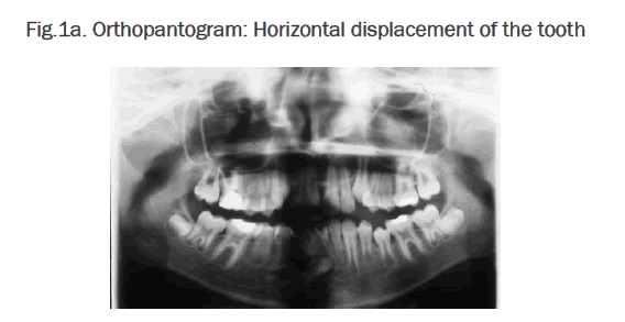 dental-sciences-Horizontal-displacement-tooth