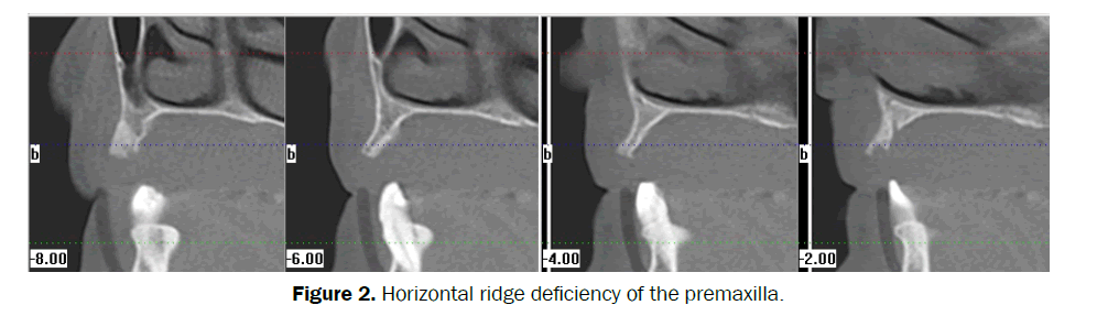 dental-sciences-Horizontal-ridge-deficiency