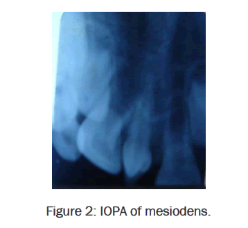 dental-sciences-IOPA-mesiodens