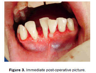 dental-sciences-Immediate-post-operative-picture