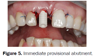 dental-sciences-Immediate-provisional-abutment