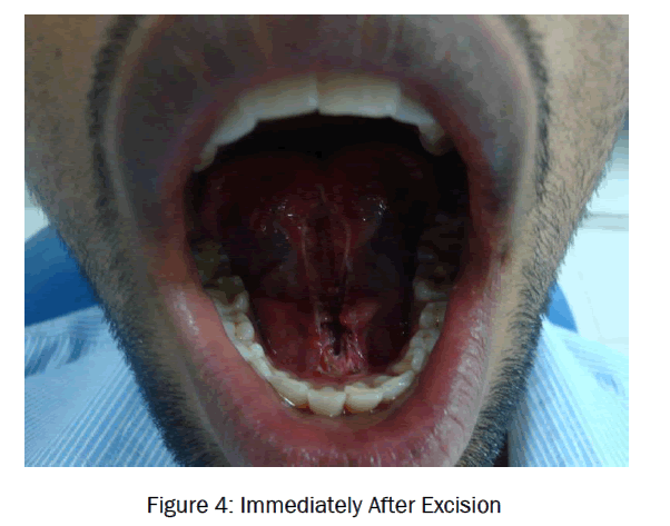 dental-sciences-Immediately-After-Excision