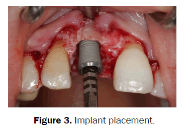 dental-sciences-Implant-placement
