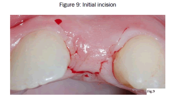 dental-sciences-Initial-incision