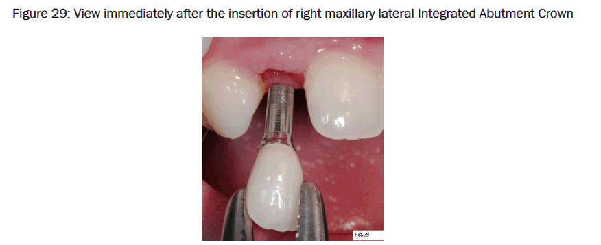 dental-sciences-Integrated-Abutment-Crown
