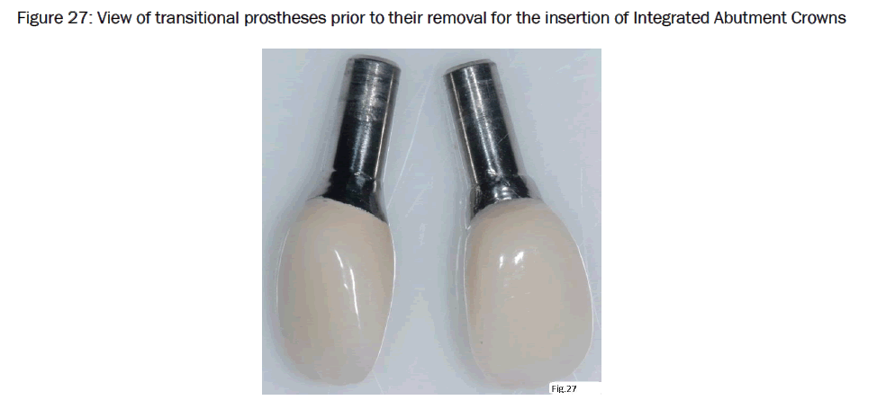 dental-sciences-Integrated-Abutment-Crowns