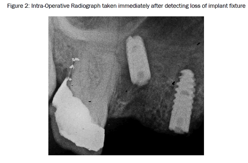 dental-sciences-Intra-Operative-Radiograph