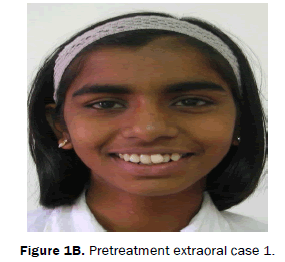 dental-sciences-Intra-Oral-Pretreatment-extraoral-case