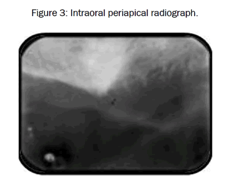 dental-sciences-Intraoral-periapical-radiograph
